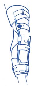 Rigide brace