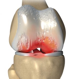 knie-artrose