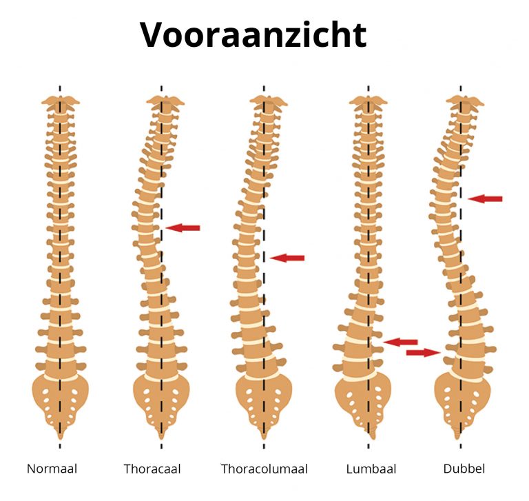 Rugpijn? - Hoe een rugbrace kan helpen - Hoe je de juiste brace kiest